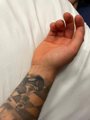 Forearm Treatment