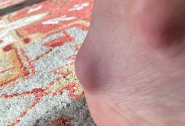Bursitis on the Achilles tendon